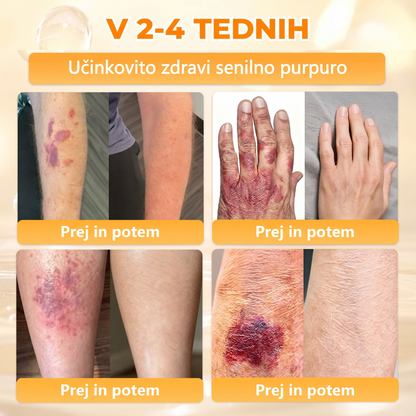 🔥🔥 Priporočilo bolnišnice   • Uradna trgovina ✨𝗗𝗼𝗿𝗺𝗼𝐫𝐧𝐚®  Krema za obnovo kože s čebeljim strupom (Copy)
